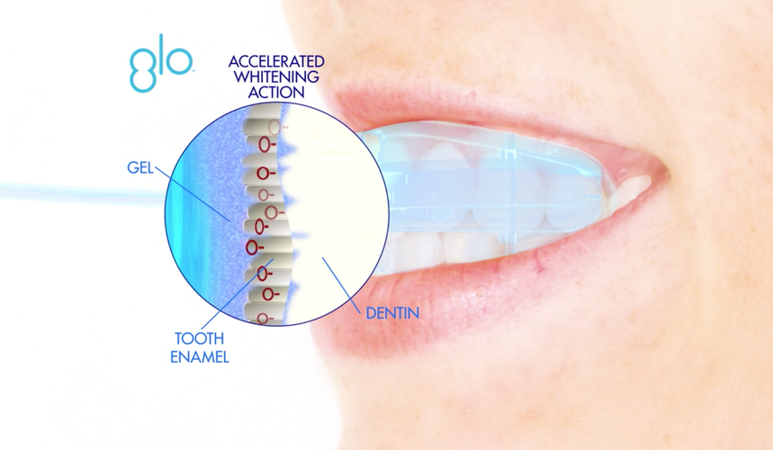 Scottsdale GLO Teeth Whitening GLO Teeth Whitening Dentist AZ